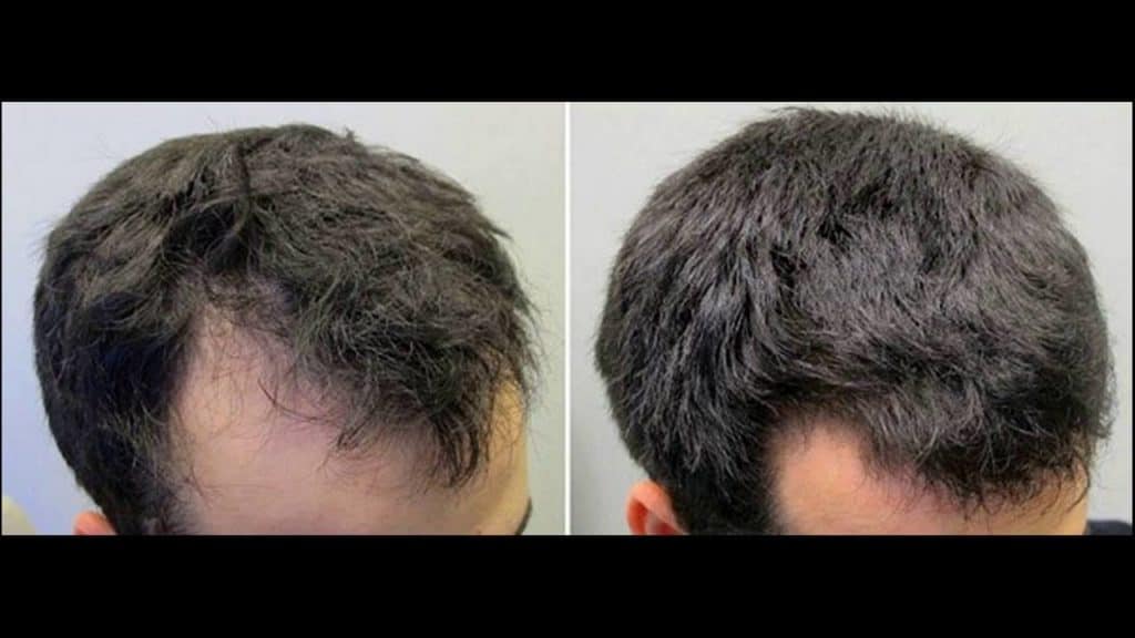 1024px x 576px - Does Masturbation Cause Hair Loss (2019 Edition)? - AntiDopamine