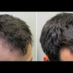 Does Masturbation Cause Hair Loss (2020 Edition)?